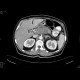 Carcinoma of pancreas: CT - Computed tomography